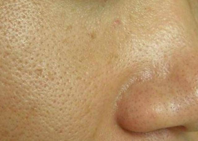 若脸上出现这4种异常,说明上亿的螨虫天天在脸上打洞,自测了解_毛孔