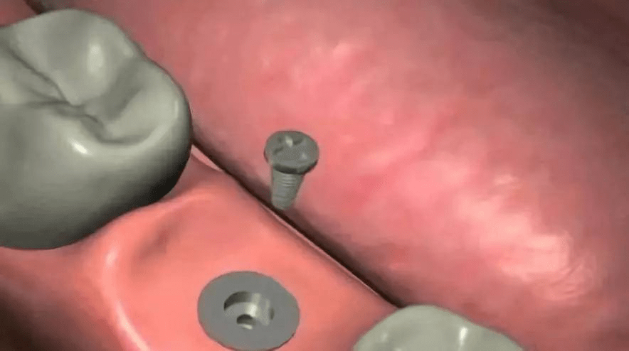 大连齿医生口腔科普 3分钟了解种植牙全过程!看后不再害怕了哦