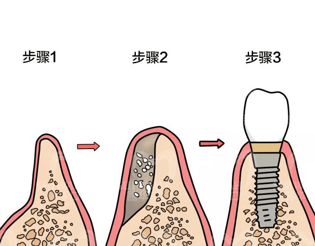 种植牙三期图解 步骤图片