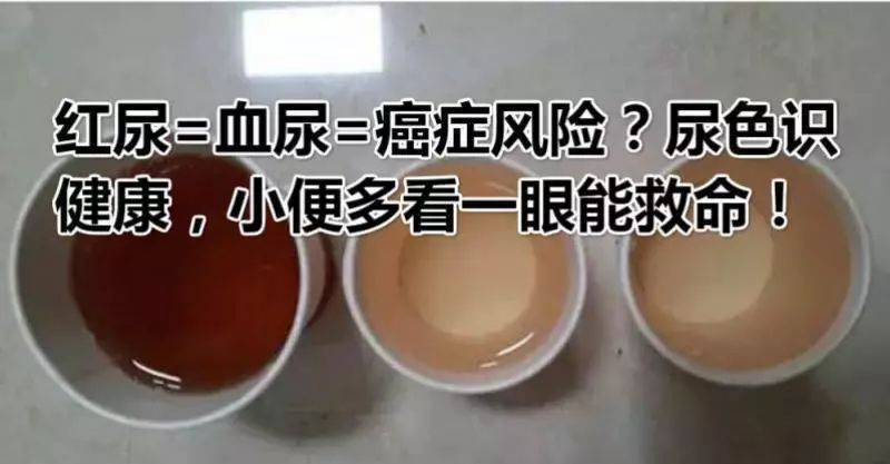 專家武敏提示:腎病多是