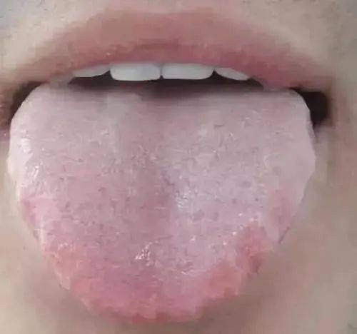 气虚的舌苔是白腻的,舌苔铺满了整个舌面,有的上面还飘着一层霜湿