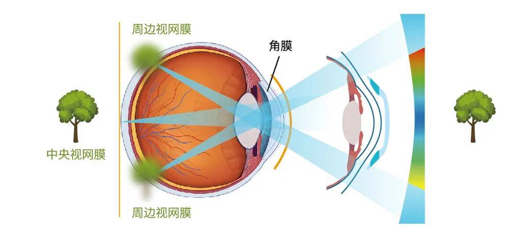 角膜塑形镜青少年近视防控好帮手太学眼科倾情献礼