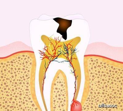 不疼牙醫還給你做根治治療,有可能你的牙髓已經是壞