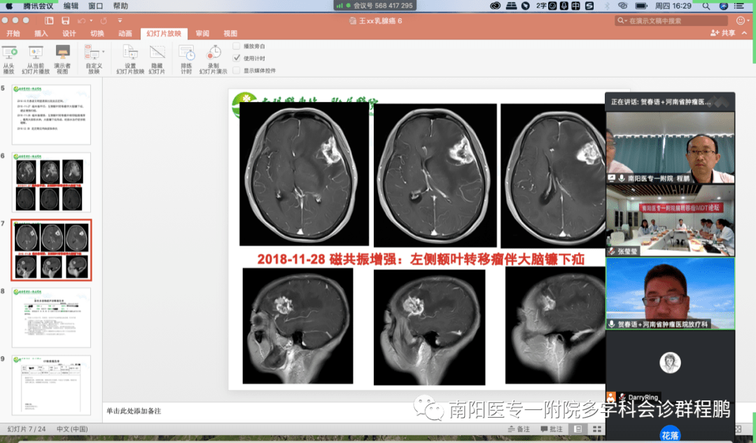 通過南陽地區首次腦轉移瘤專題的mdt討論,提高了南陽地區腦轉移瘤治療