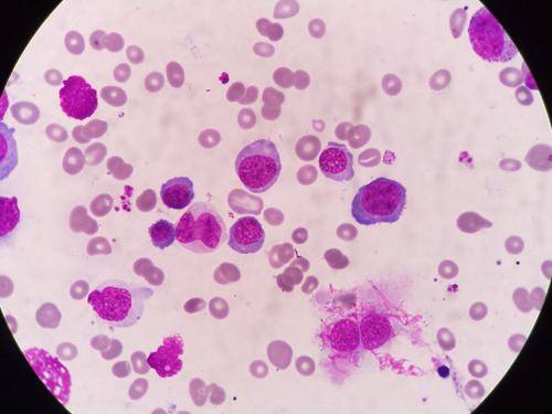 巨幼红细胞性贫血是由于叶酸或维生素b12缺乏,所导致的大细胞性贫血