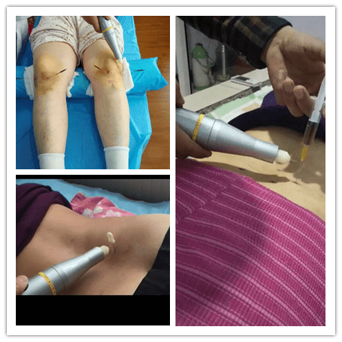 高频电火花水针疗法