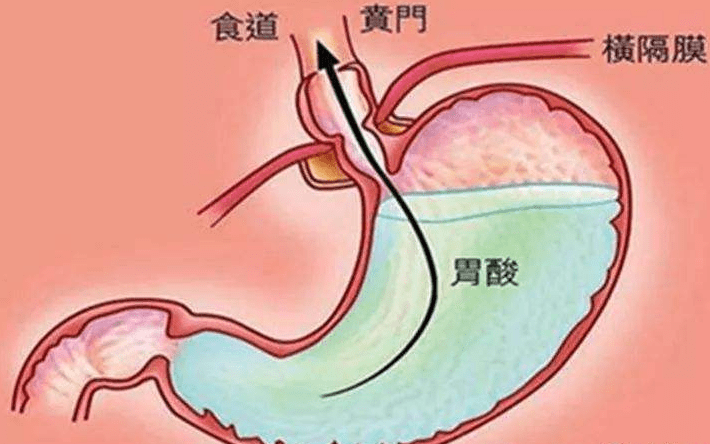 提醒:这种胃反酸很危险_胃酸