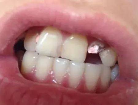 牙脱位后,找回折断的牙齿,如果牙齿连根折断或脱落,可以用纯净水冲洗