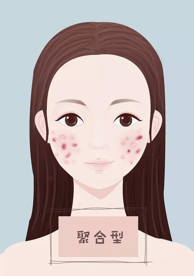 长痘这么多年,你知道你痘痘的类型吗?