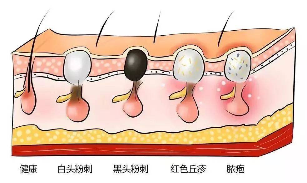 毛孔粗大,黑头,皮肤干燥~这样做,14天皮肤滑得像磨皮!