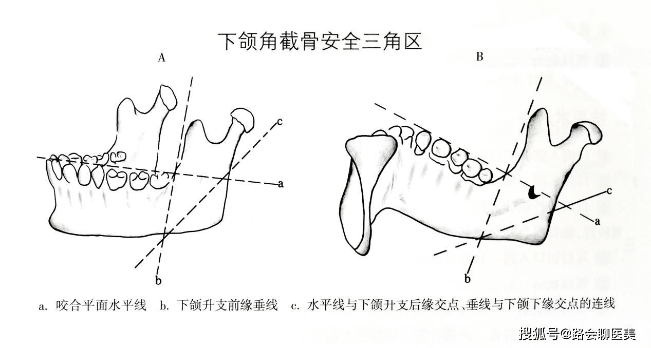 瘦脸|大方脸变瓜子脸,下颌骨应该这么截才安全!
