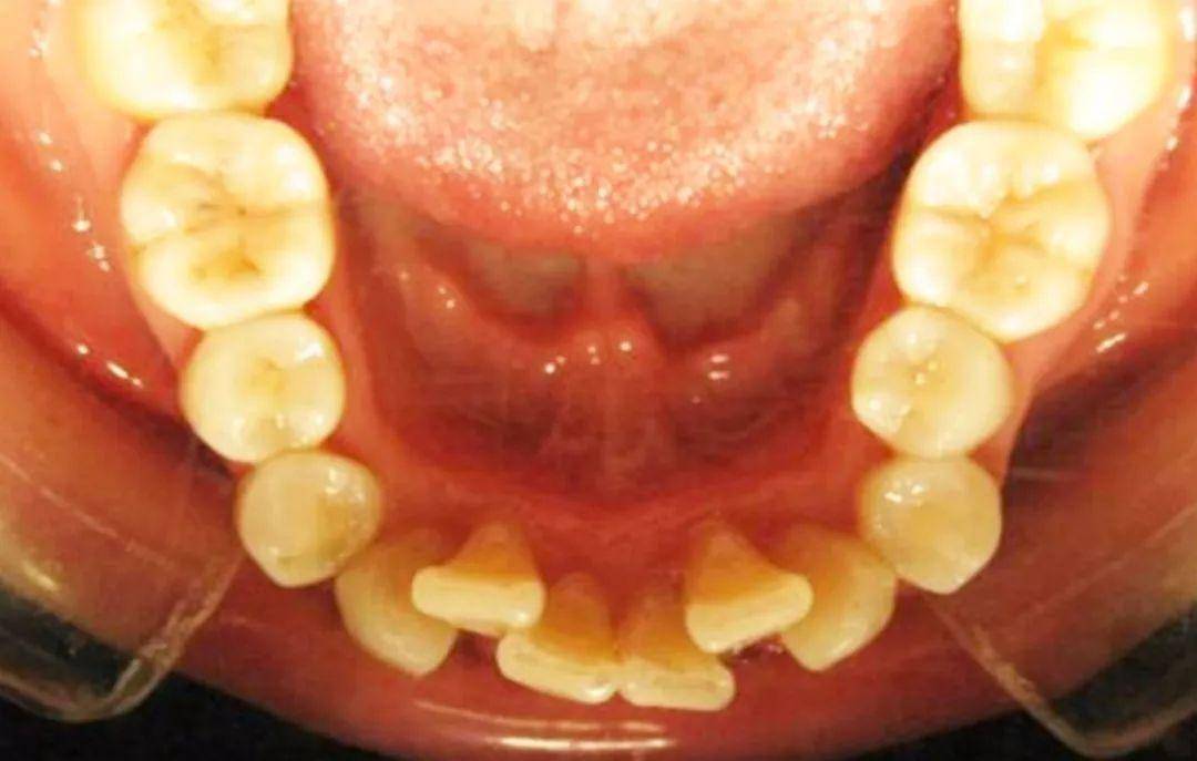 武漢存濟口腔醫院牙齒又擠又歪拔牙矯正適合我嗎