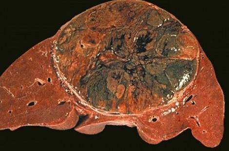 原发性肝脏恶性肿瘤起源于肝脏的上皮或间叶组织