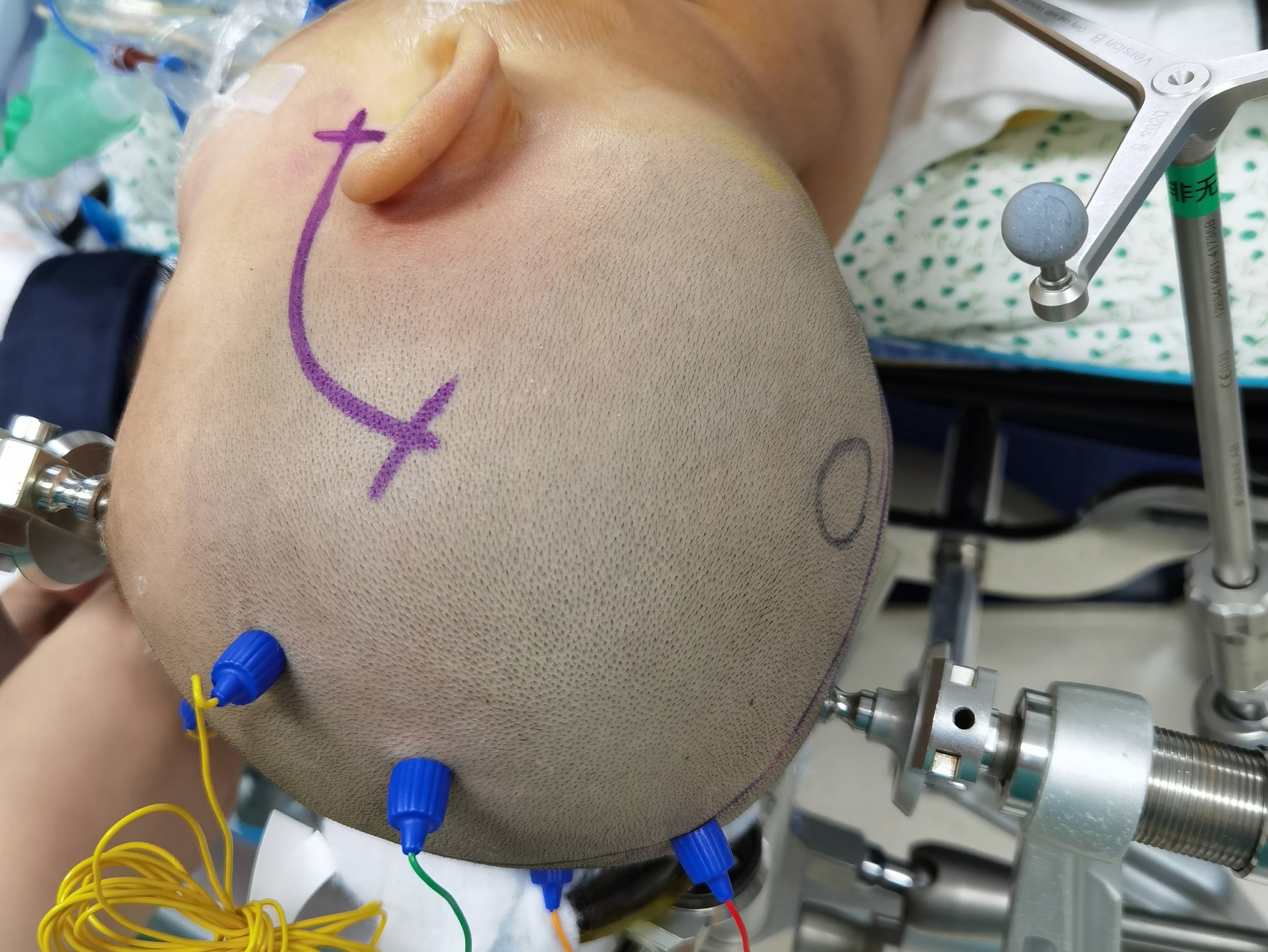 原创儿童脑干肿瘤——中脑肿瘤手术全切除