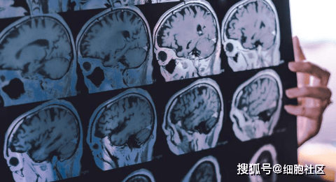 醫學|了解阿爾茨海默氏癥和癡呆癥的醫學差異