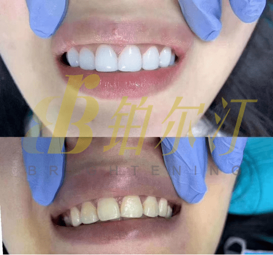 铂尔汀|为什么铂尔汀被称作"美牙不磨牙"的佼佼者?