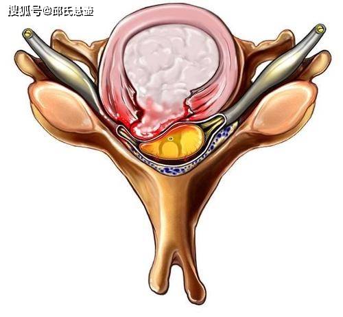 邱腰椎:腰椎間盤突出,腰痛,腿麻後需要注意哪幾點?