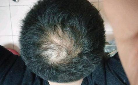 22岁小伙雄秃3年多,熬过了狂脱期,却还是逃不掉秃顶的命运