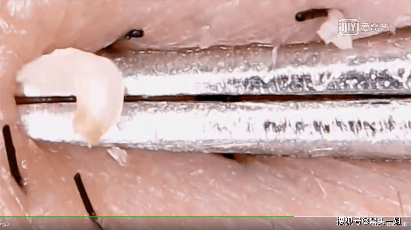 什么黑头也有真假如何分辨真黑头和假黑头