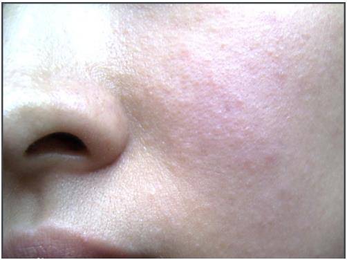 敏感肌痘痘肌可以用公主家护肤品吗?