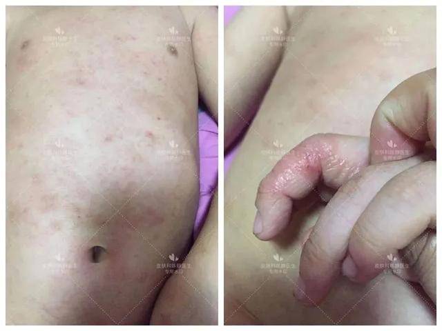 痒痒痒,全世界有2.3亿人被它"缠身"