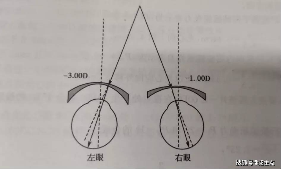 科普篇丨屈光參差與斜視