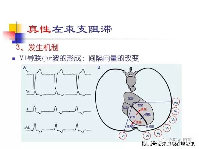 左束支阻滞性心肌病