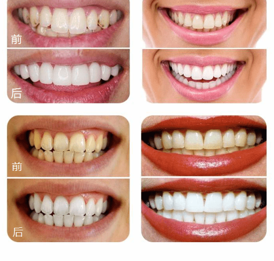 一口大黄牙有多可怕?再贵的口红也白搭!
