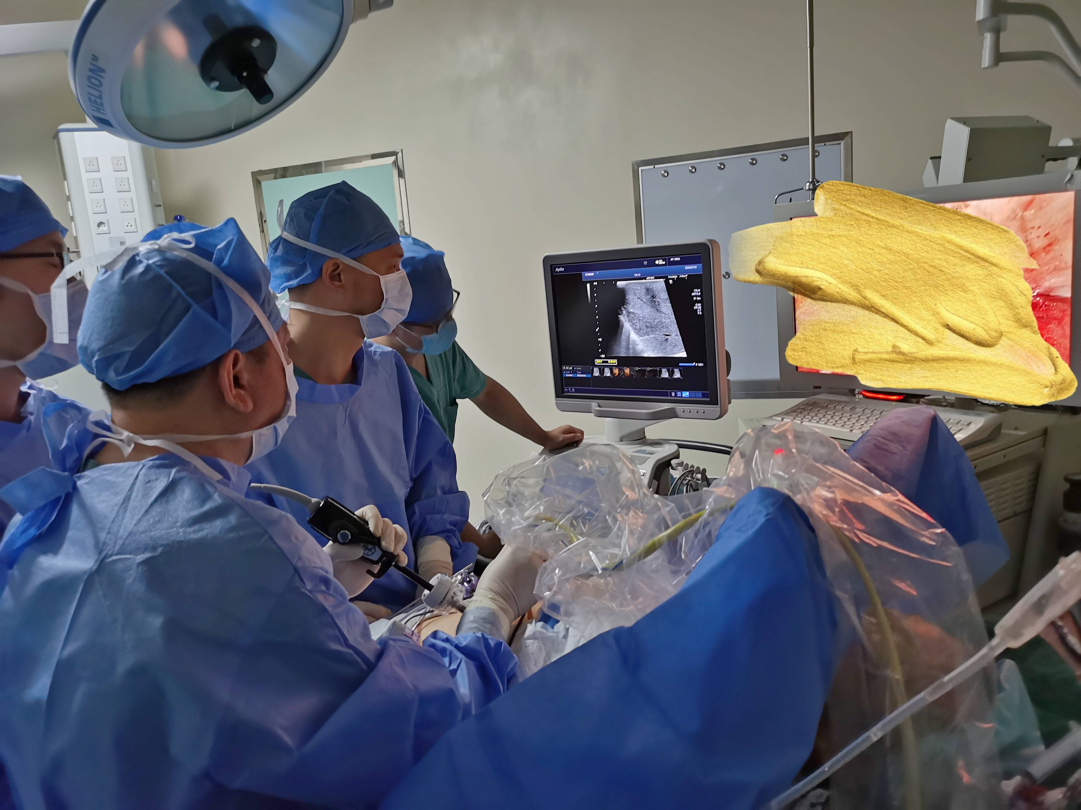 给医生点赞七旬老汉肝癌复发手术次日竟能下床走动