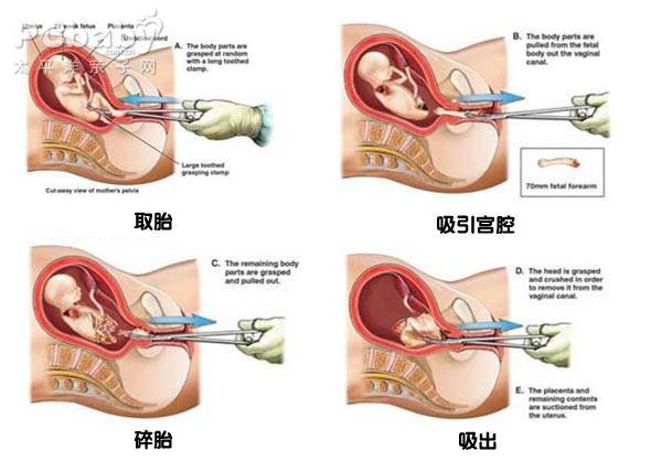 人流最佳时间 怀孕多久可以做人流