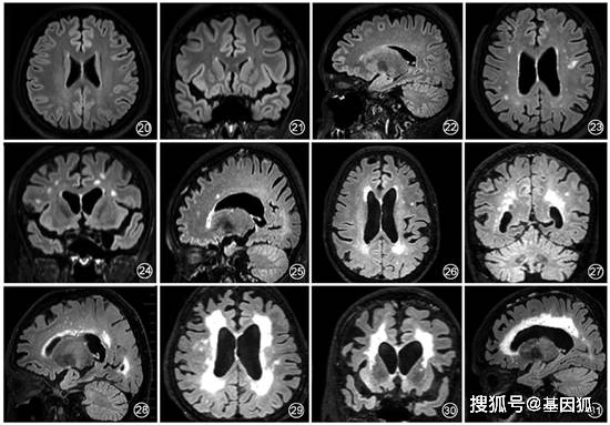 阿爾茨海默病mr檢查規範中國專家共識_海馬