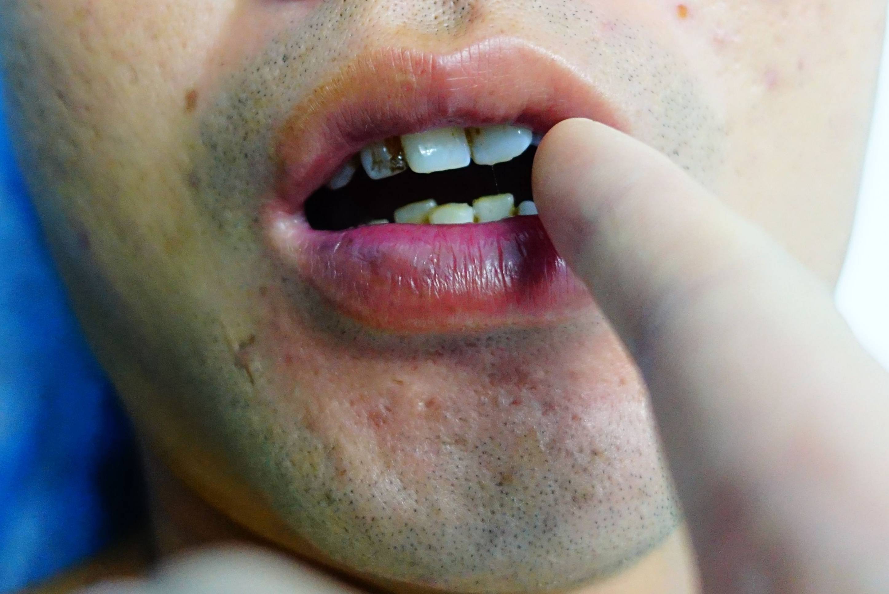 令人 棘手的是,吴先生口腔左颊侧黏膜纤维化,出现两条白色绳索状,像"