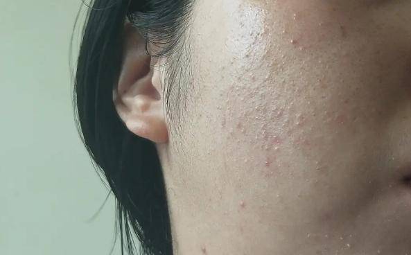 闭合性粉刺和痘痘是不是一样的祛除痘痘正确的方法是什么