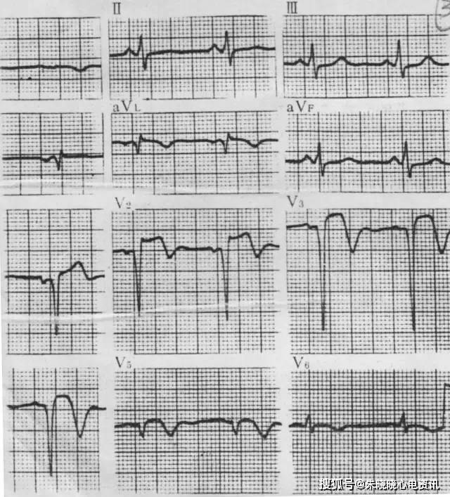 心电图复极变化1,缺血性t波变化(1)t 波形态改变:双肢对称,波形变窄