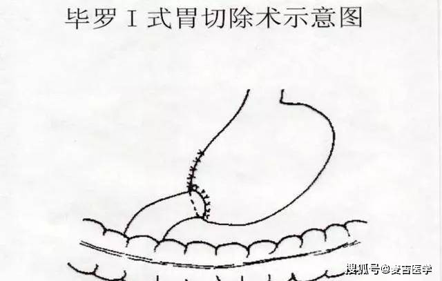 胃大部切除术毕二式图片