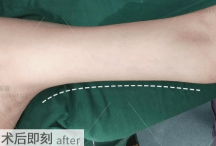 并且过于粗壮的上臂与下臂比例失调,影响整体美观度.术前设计