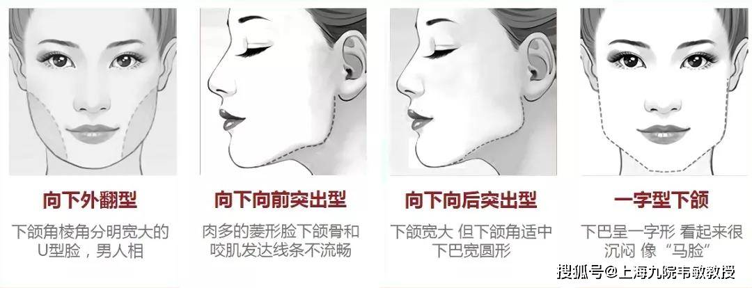 韦敏教授经验分享丨下颌角截骨怎么截看起来更自然?