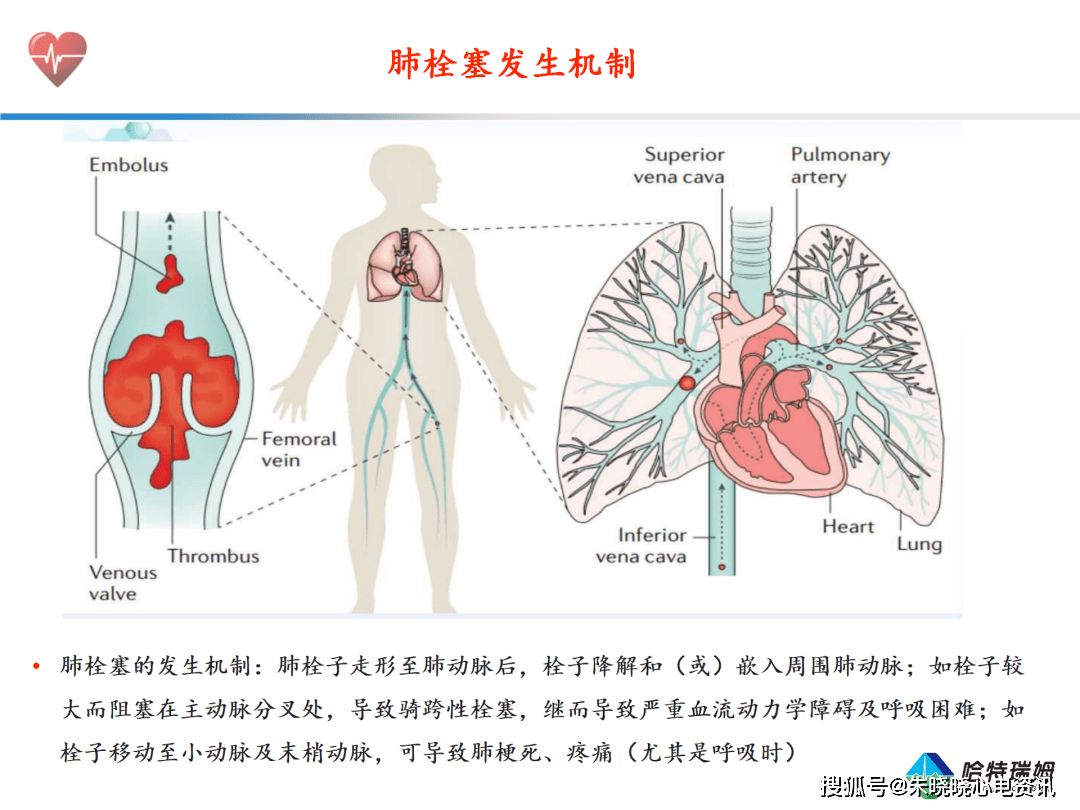 肺栓塞的机制图图片