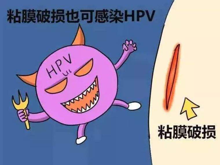 纖美淨道婦康hpv和tct都是在篩查宮頸癌哪個更準