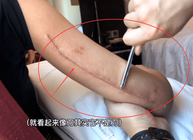 万茜手臂骨折引争议,工作室拿出证据,看到她伤口那刻,懵了_胳膊