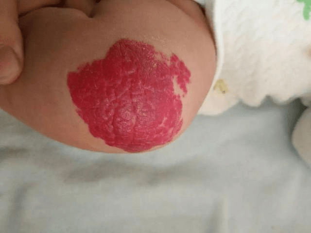 婴儿身上有红色的块状图片
