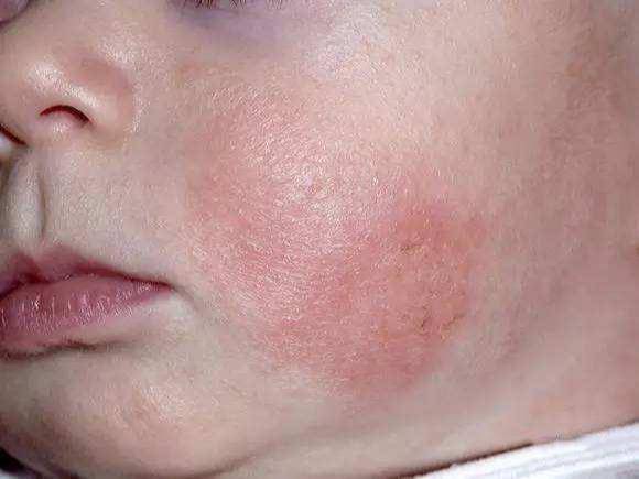 都会带来环境干燥的问题,宝宝长时间在干燥的环境中,就会出现皮肤皴裂