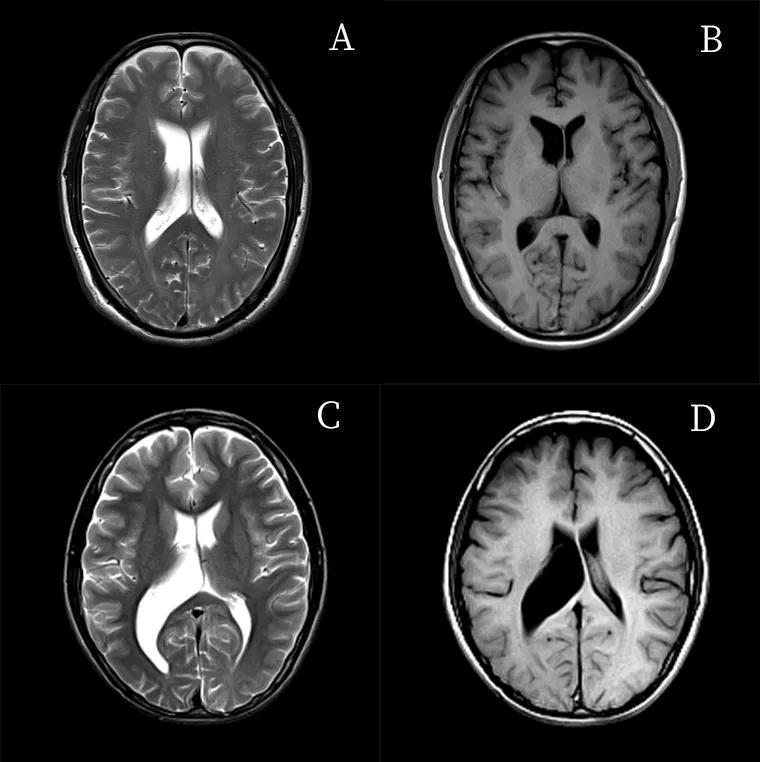 影像表現:a,b 為同一患者,頭顱 mri 平掃橫斷位 t2wi(a)和 t1wi(b)