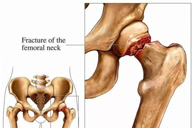 68歲闞大爺髖部骨折,1年後去世,老年人這個部位骨折很要命
