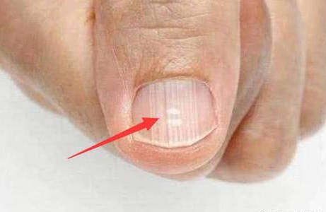 指甲表面有明显的竖纹是怎么回事?