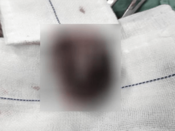 原创少年下身又红又肿,家人焦头烂额,专家检查后:现在只能切除了