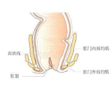 這到底是痔瘡還是肛裂