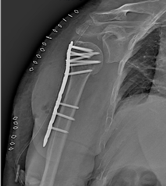 胡医生|【杭州城东医院丨案例】“新技术”为“肱骨近端粉碎骨折”患者复原