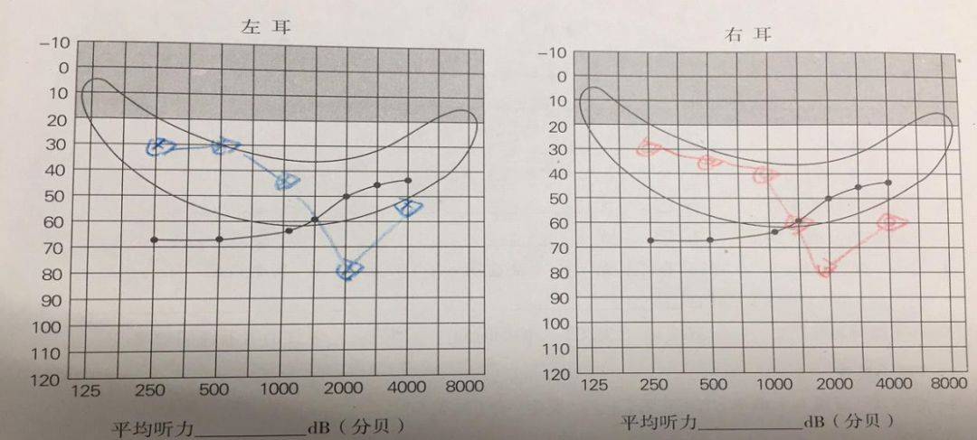 高频陡降听力该怎么办济南助听器