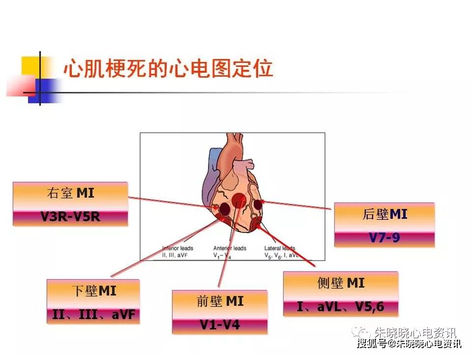 心肌梗死相关知识ppt